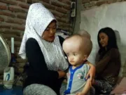 Butuh Uluran Tangan, Anak Tukang Gorengan di Serang Menderita Hydrocephalus