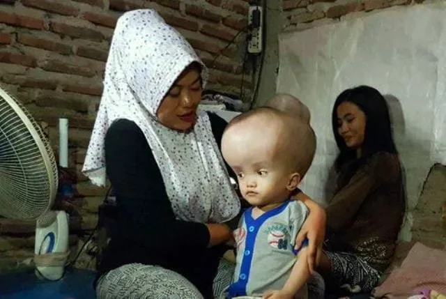 Butuh Uluran Tangan, Anak Tukang Gorengan di Serang Menderita Hydrocephalus